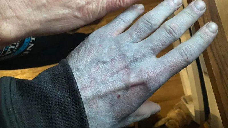 段子成真😅英国男子Tommy Lynch一觉醒来发现自己变成了阿凡达，皮肤变蓝，紧急送医后发现是他的床单掉色了……Tommy Lynch说